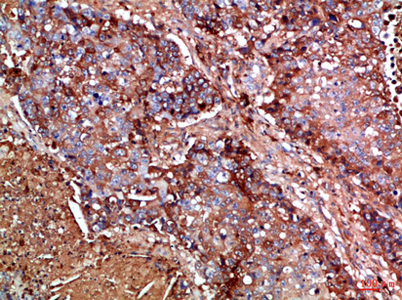 Immunohistochemical analysis of paraffin-embedded Human-lung-cancer, antibody was diluted at 1:100 Immunohistochemical analysis of paraffin-embedded Human-lung-cancer, antibody was diluted at 1:100