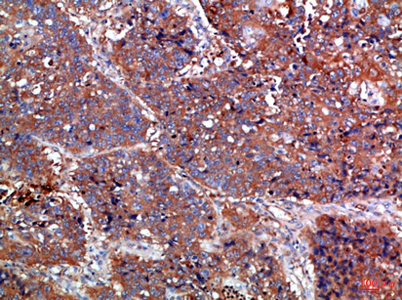 Immunohistochemical analysis of paraffin-embedded Human-lung-cancer, antibody was diluted at 1:100 Immunohistochemical analysis of paraffin-embedded Human-lung-cancer, antibody was diluted at 1:100